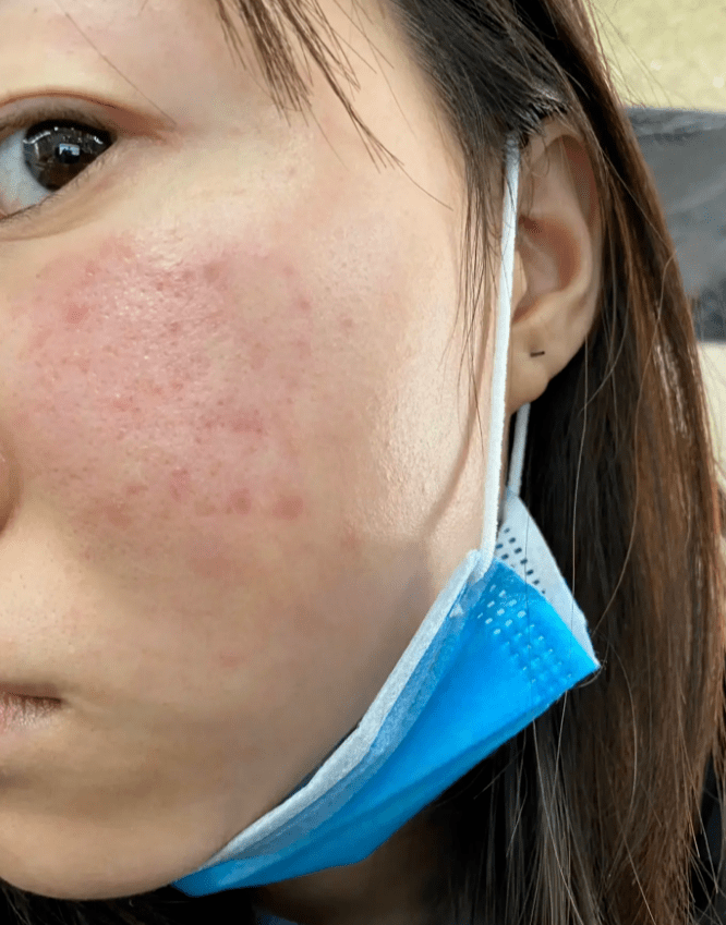 小虎爱吃鸡苹果版:我不允许还有人不知道这个去脂溢性皮炎的方法！